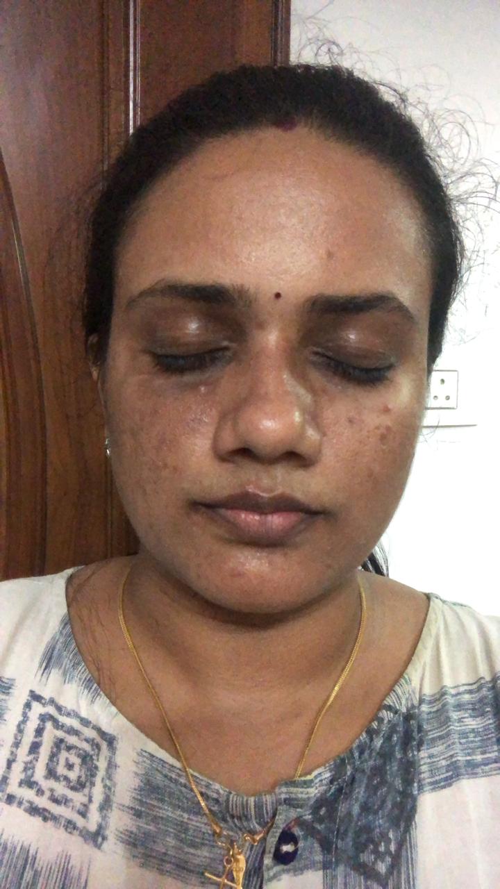 Chronic Burn Care - After