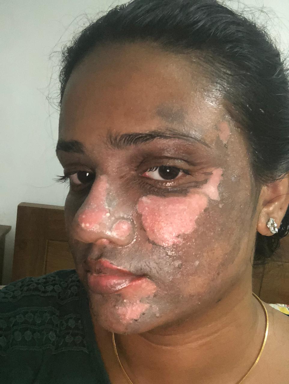 Chronic Burn Care - Before
