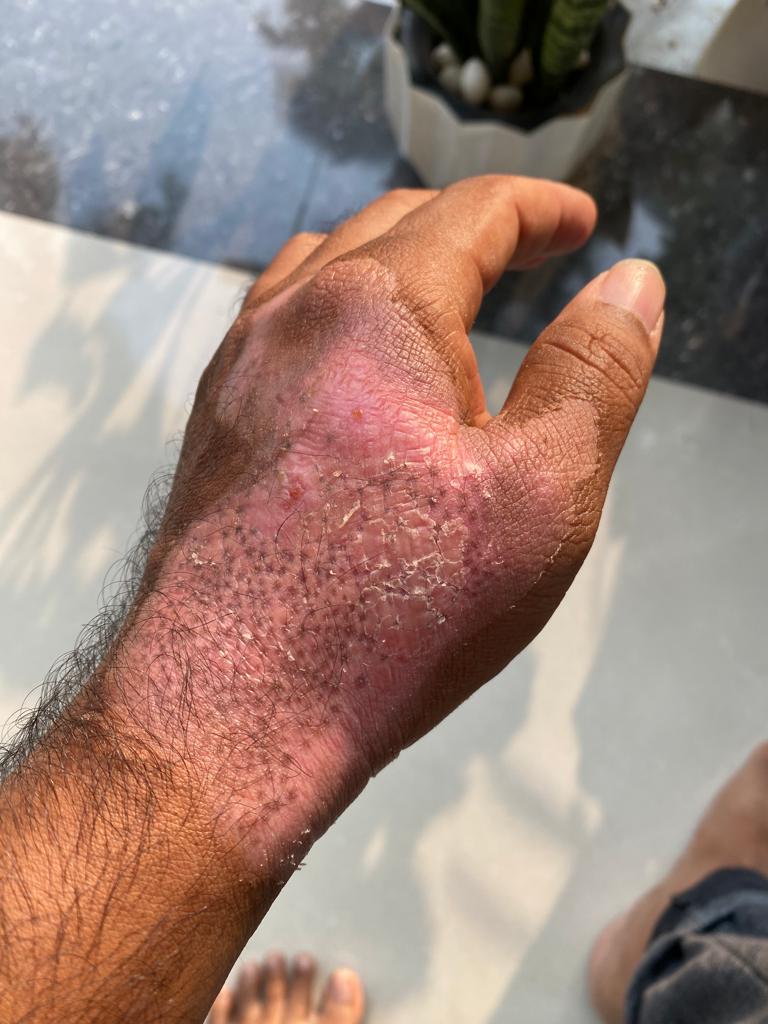 Wound Support - After