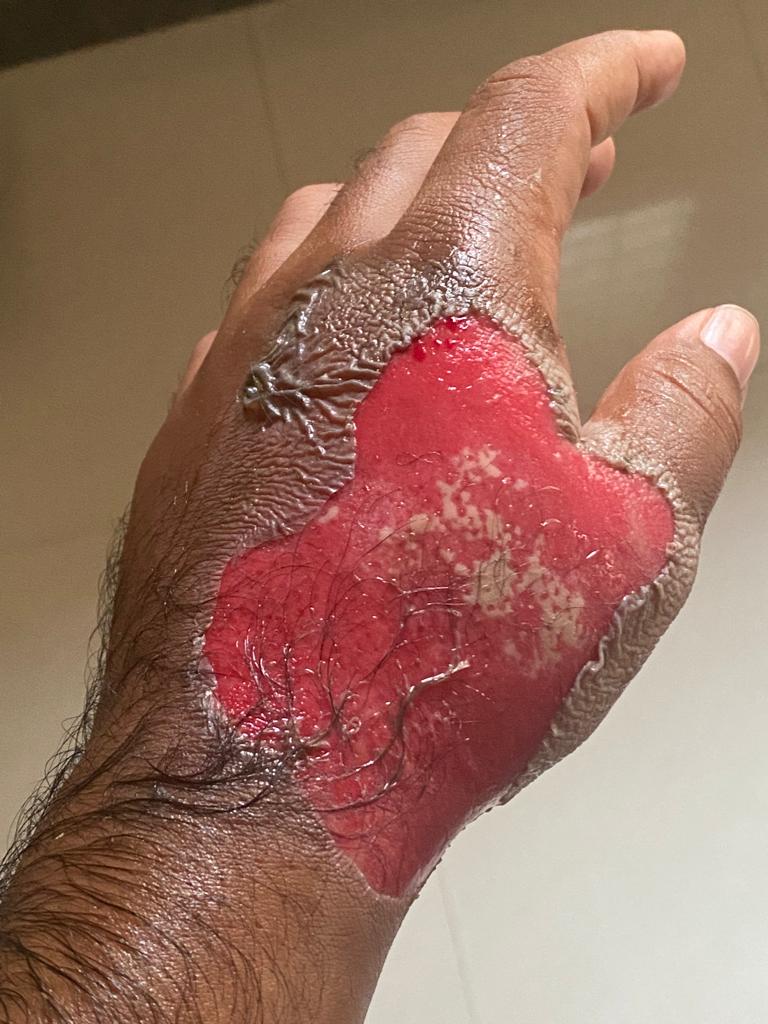 Wound Support - Before