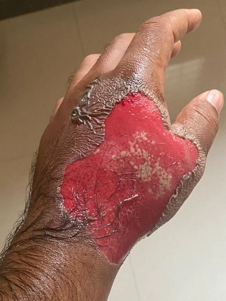Wound Support - Before